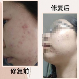 痘肌救星黎蓓露，令我重拾职场自信！